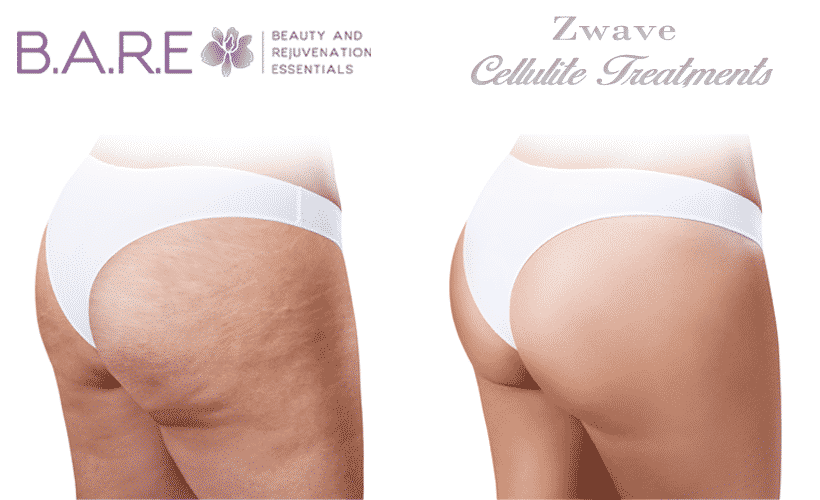 Cellulite Treatment In Etobicoke & Greater Toronto - Laserlicious