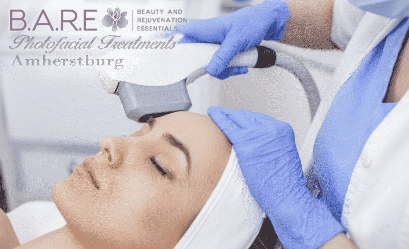 Photofacial Treatments Amherstburg