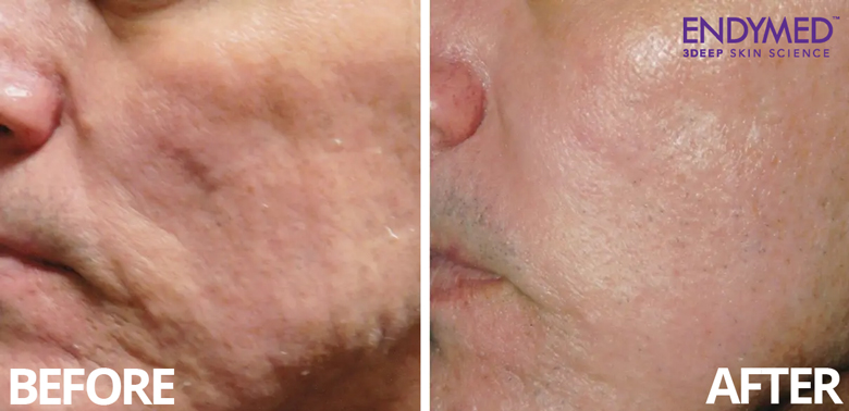 Deep Skin Tightening