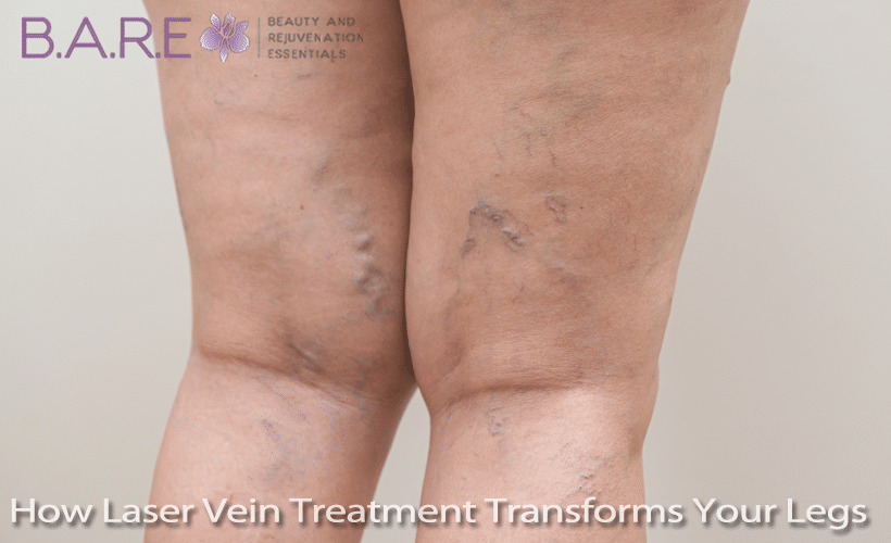 Laser Vein Treatment for Legs