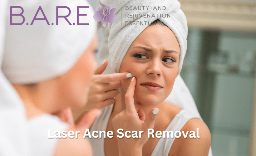 Laser Acne Scar Removal